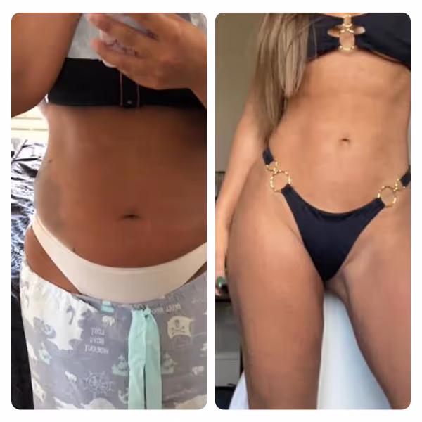 Liposuction in Turkey